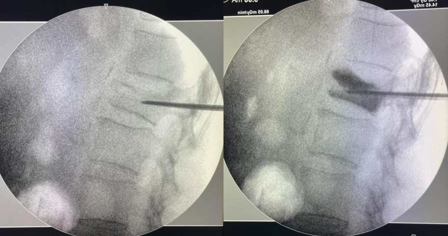 cifoplastia