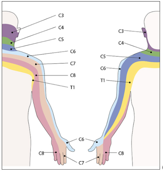 grafico hernia discal