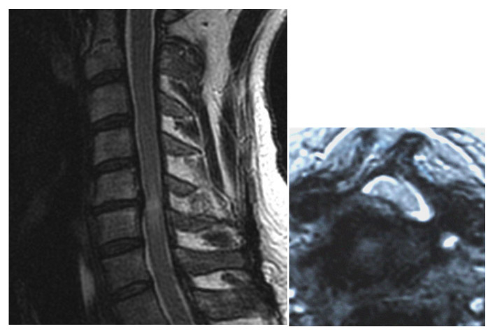 hernia discal cervical