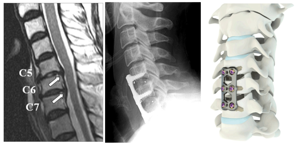 procedimiento quirurgico hernia discal cervical