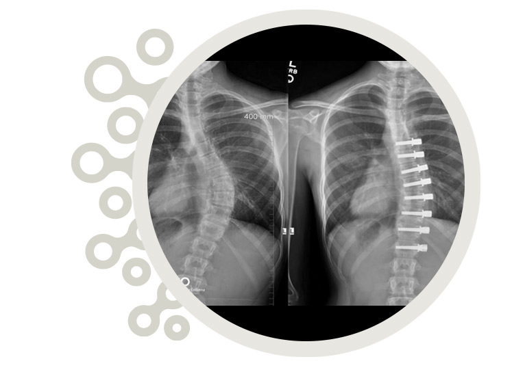 vertebral body tethering